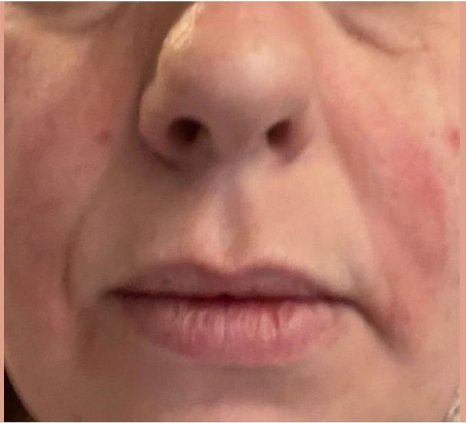 CPAP Skin Problems Rashes, Sores, Irritation, & Dermatitis